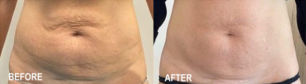 abdomen-before-after