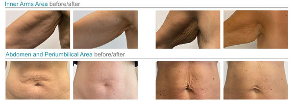 arms-abdomen-befores-afters