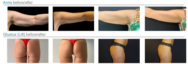 arms-gluetus-befores-afters