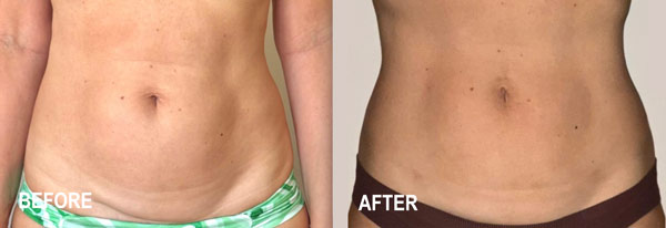 stomach-before-after